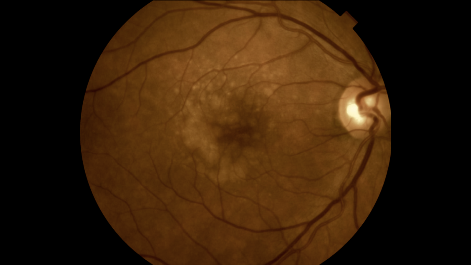 DMRI – DEGENERAÇÃO MACULAR RELACIONADA À IDADE