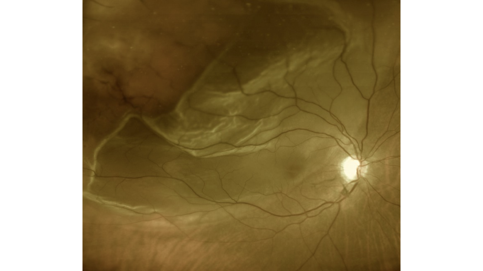 DESCOLAMENTO DE RETINA