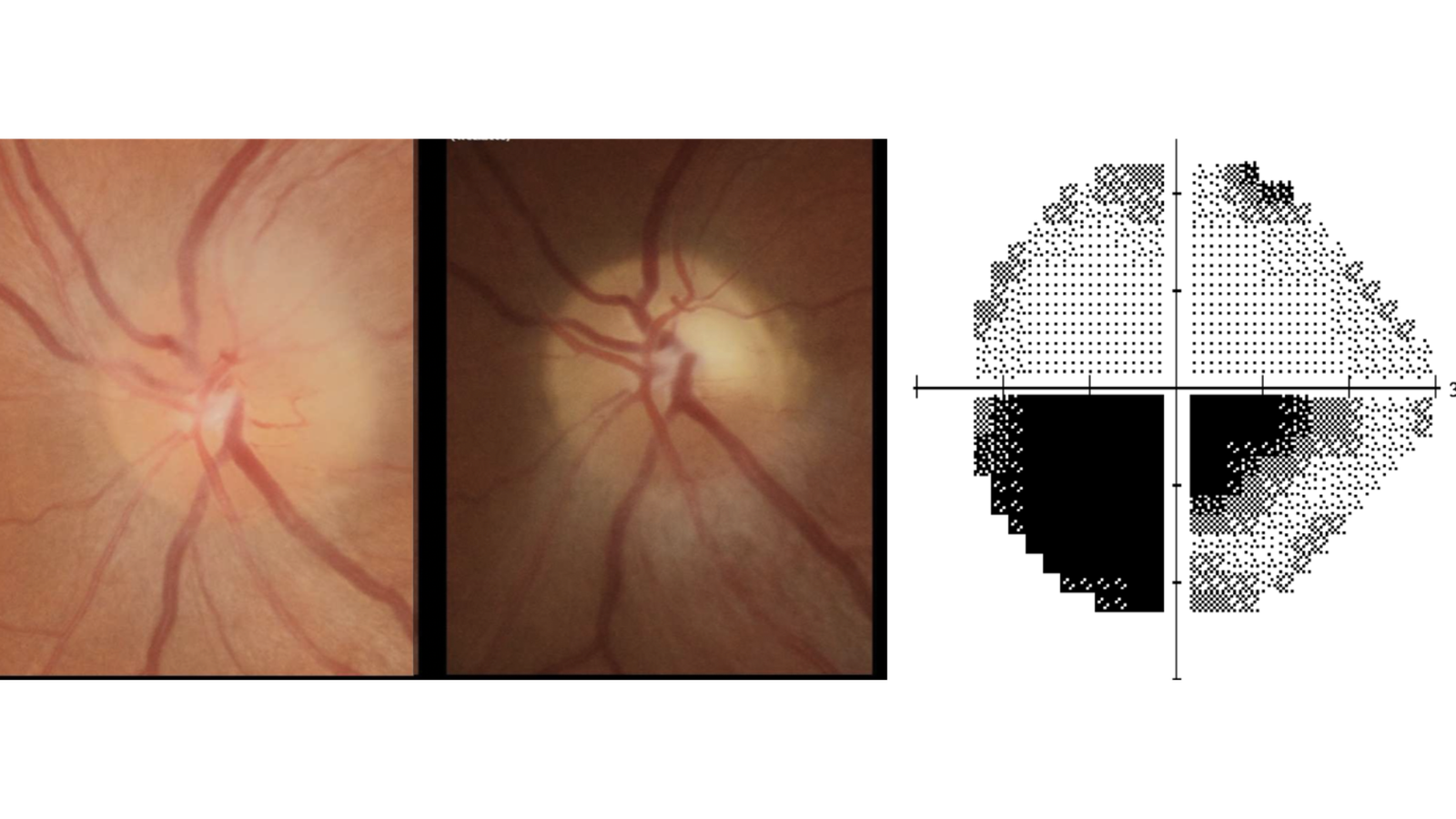 NEUROPATIA ÓPTICA ISQUÊMICA ANTERIOR (NOIA)
