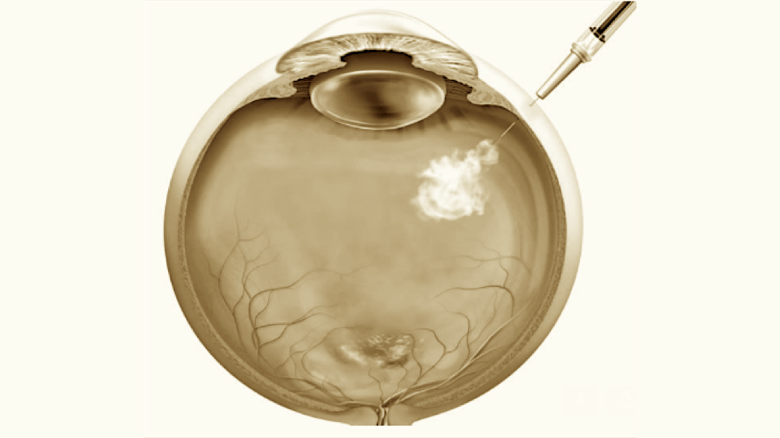 INJEÇÕES INTRAOCULARES