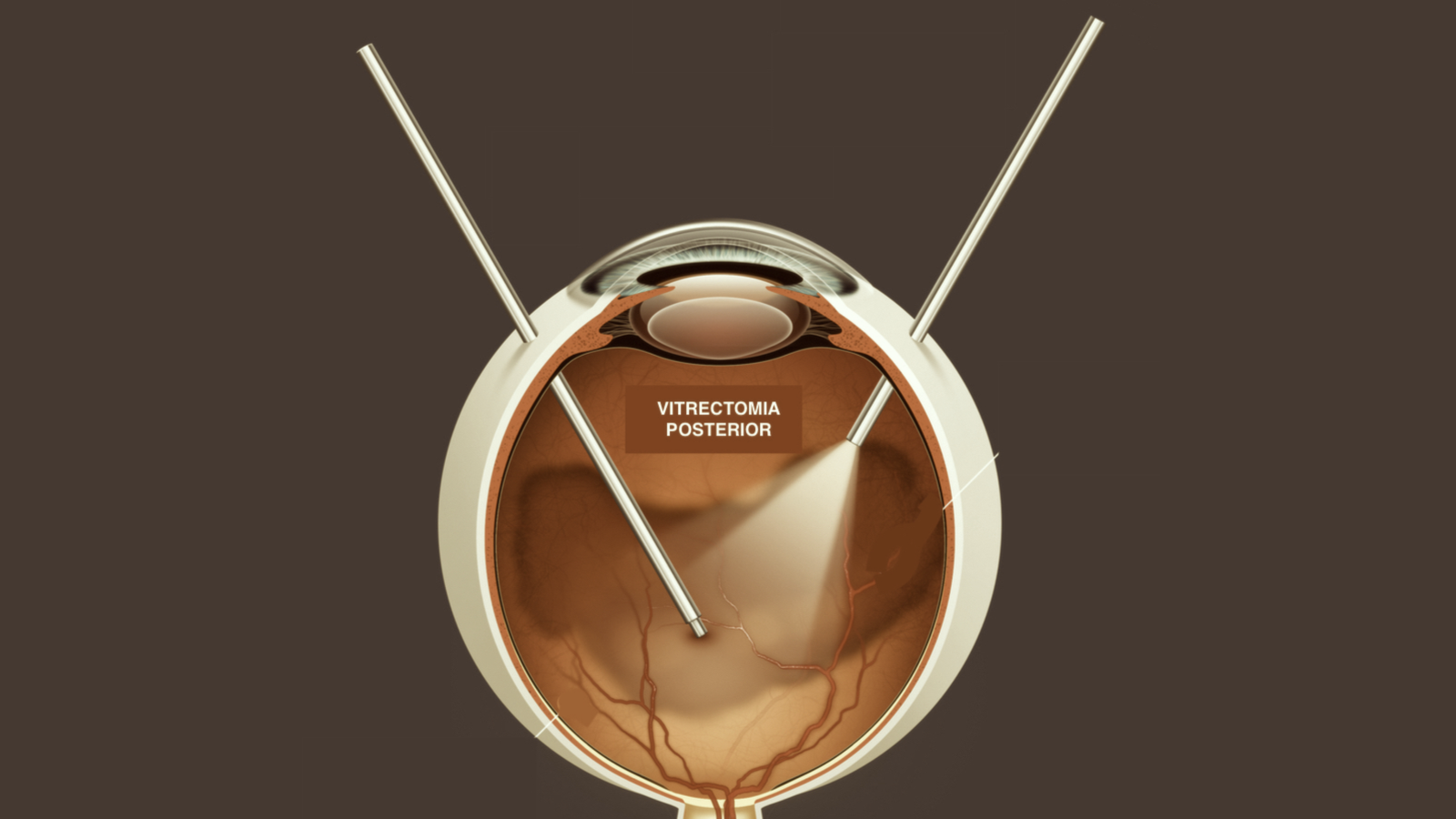 VITRECTOMIA POSTERIOR